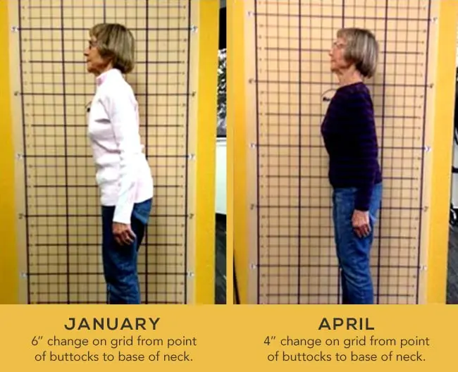 OsteoStrong company-provided posture comparison photo, member location not specified