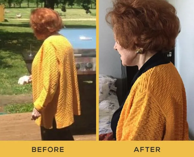 OsteoStrong company-provided before and after photo, member location not specified